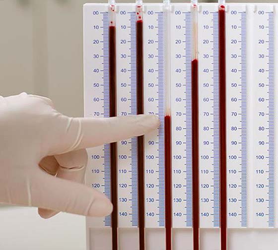Blutsenkungsgeschwindigkeit wird im Labor gemessen