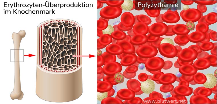 Polyzythämie: primäre Polyglobulie