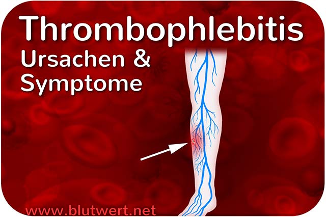 Thrombophlebitis - Ursachen und Symptome