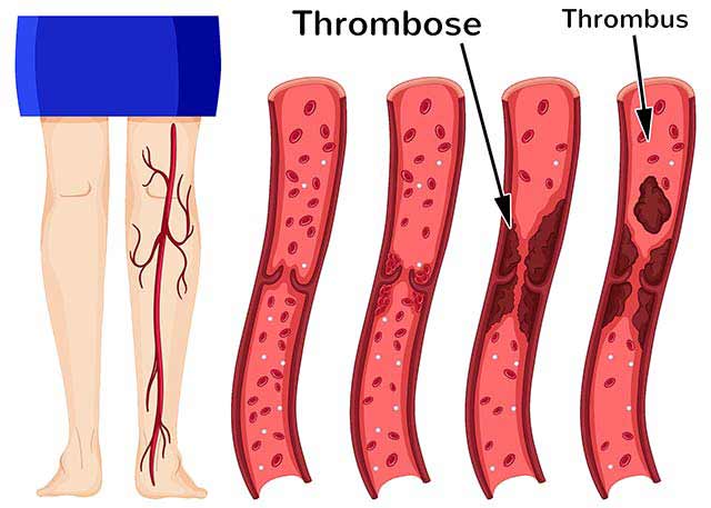 Entstehung einer Thrombose in den Beinvenen